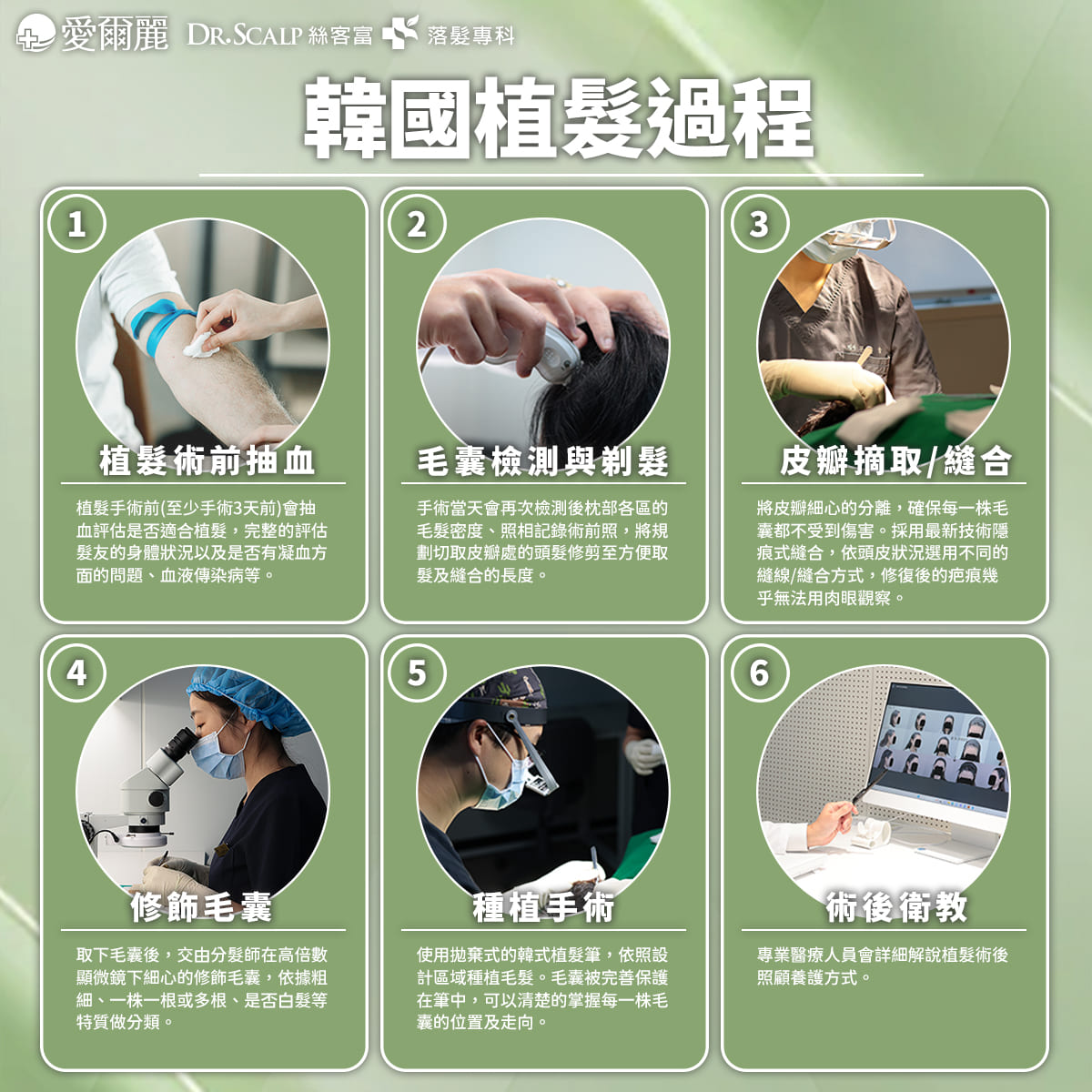 植髮手術-5